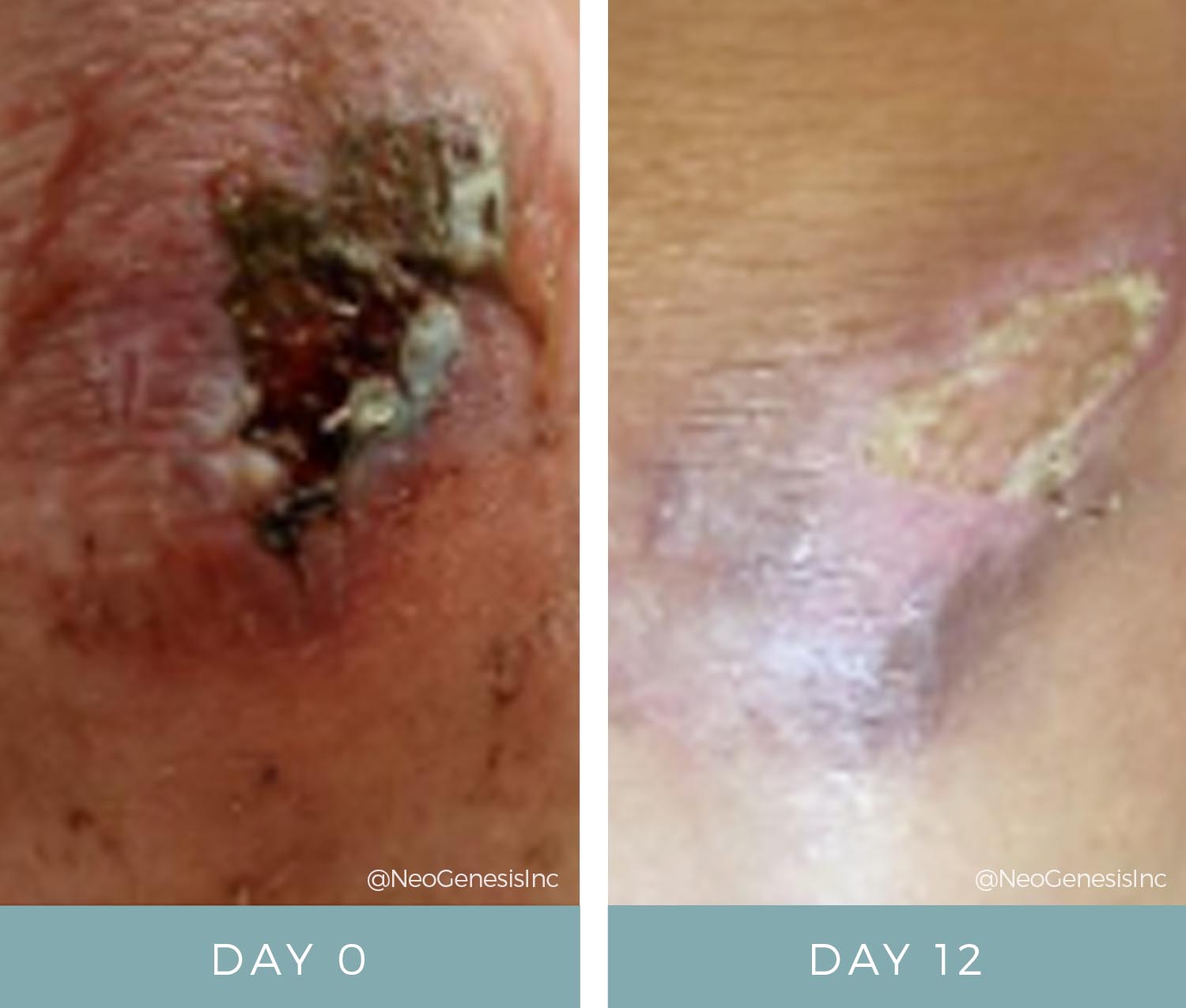 Wound Care Before + After