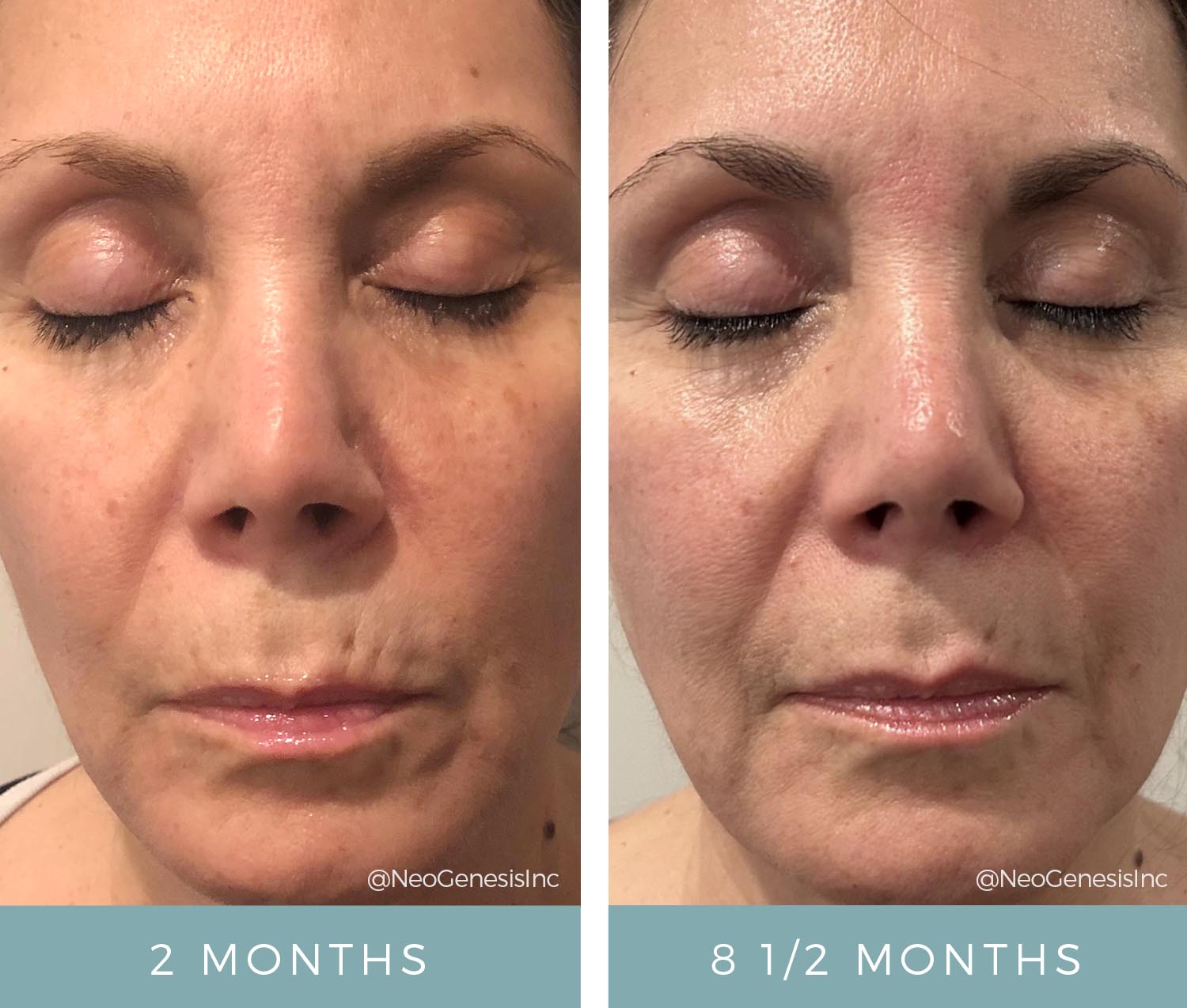 Closeup - Before + After Aging Skin
