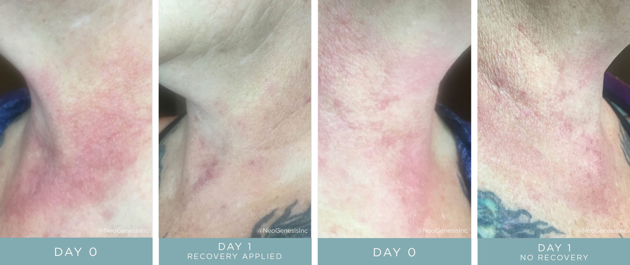 Before + After - Chemical Peel - with NeoGenesis Recovery serum and without