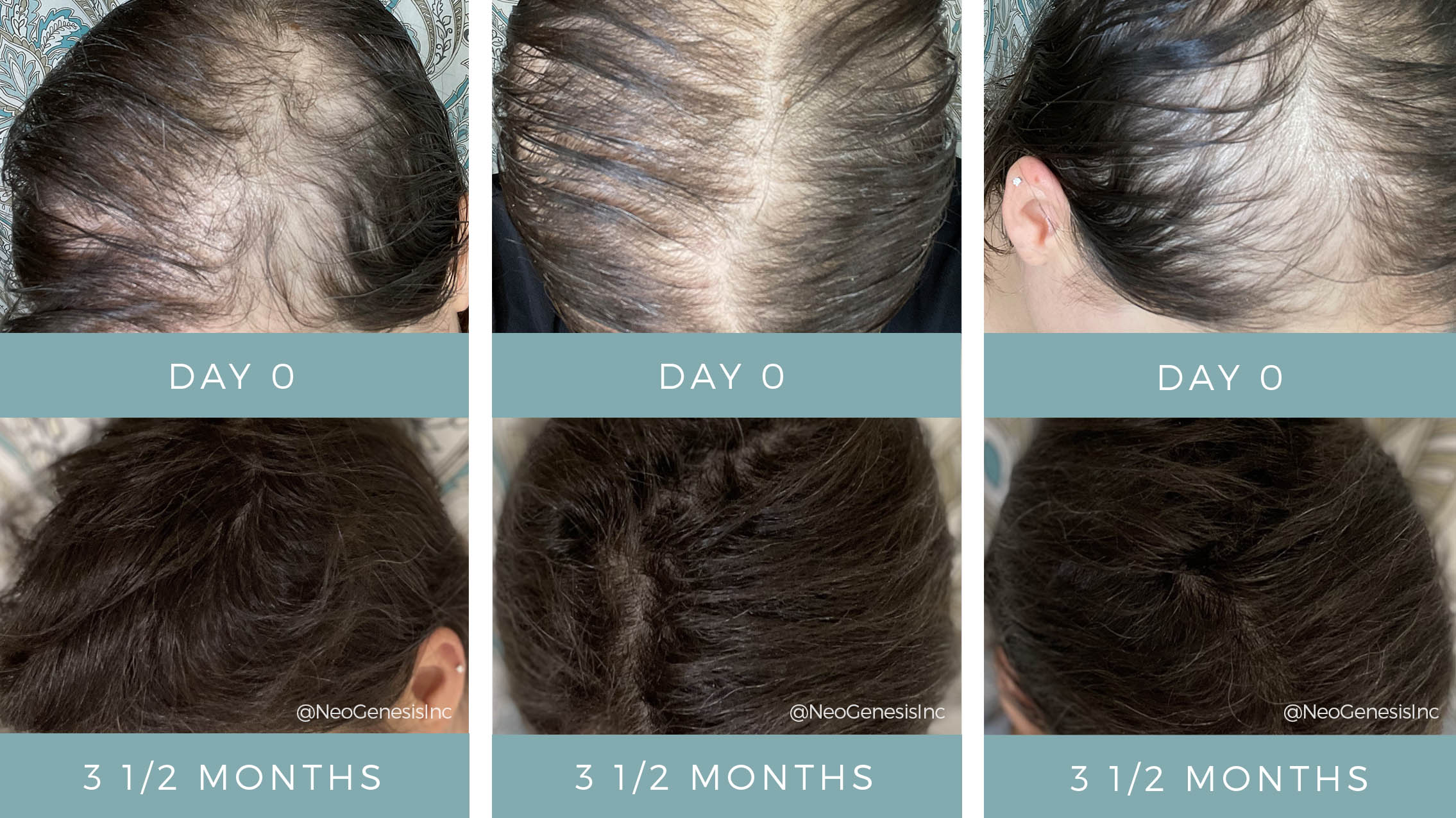 chemotherapy-hair-loss-neogenesis-hair-thickening-serum