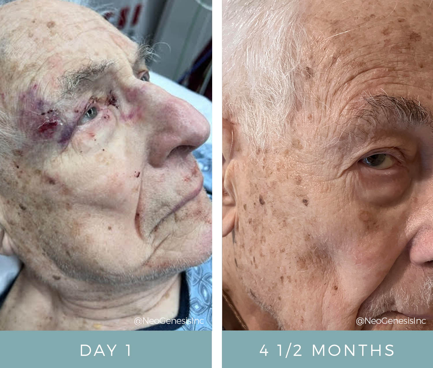 Before + After - Wound Care - Open wound from fall