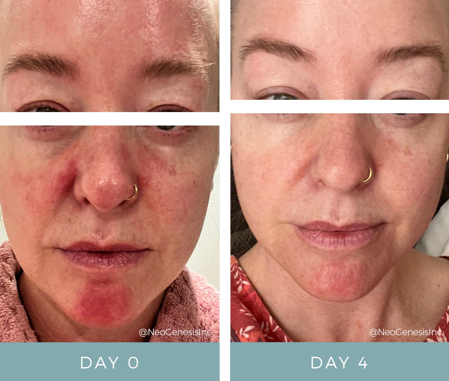 Before + After - Perioral Dermatitis