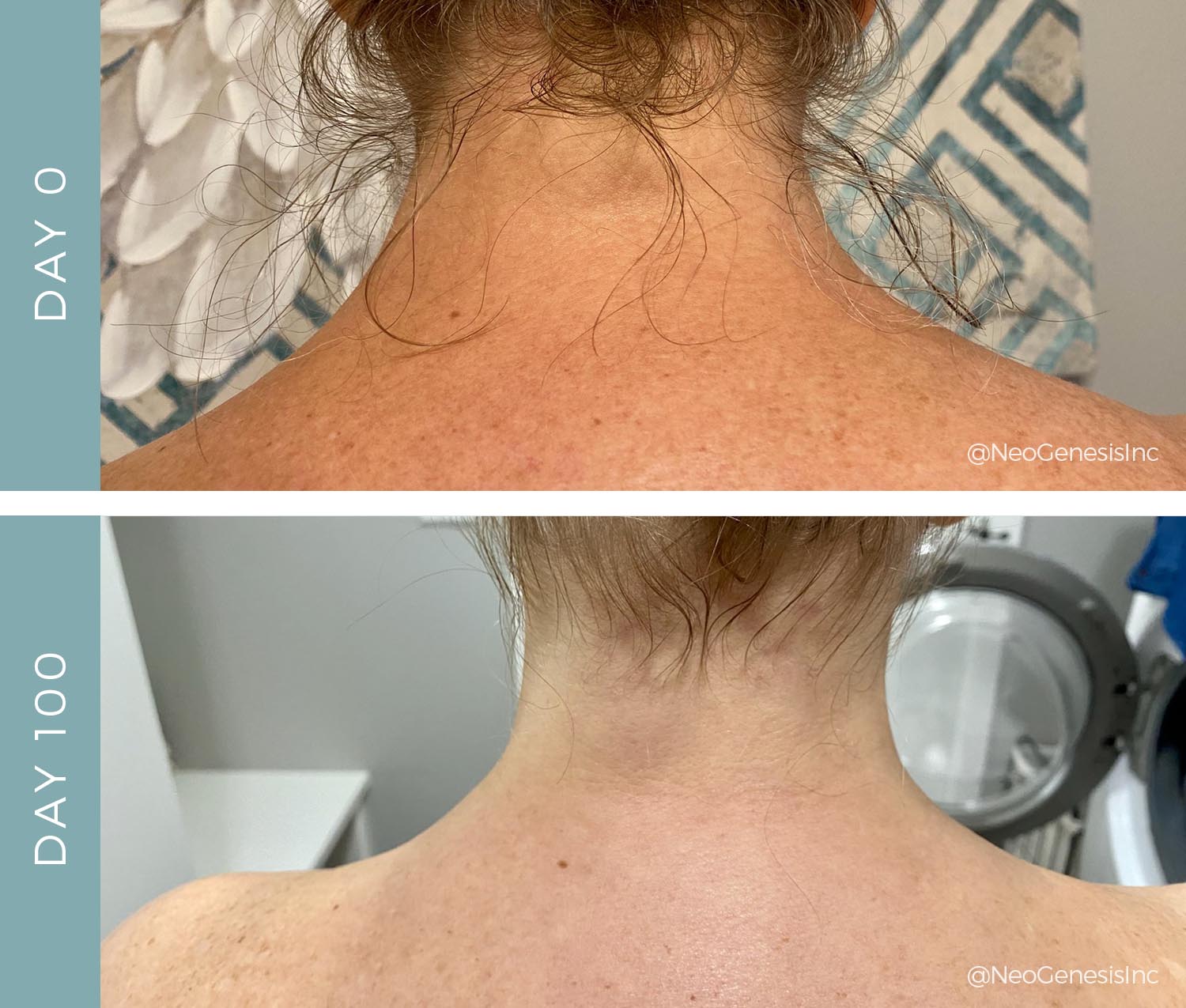 Before + After - Radiation + Chemo