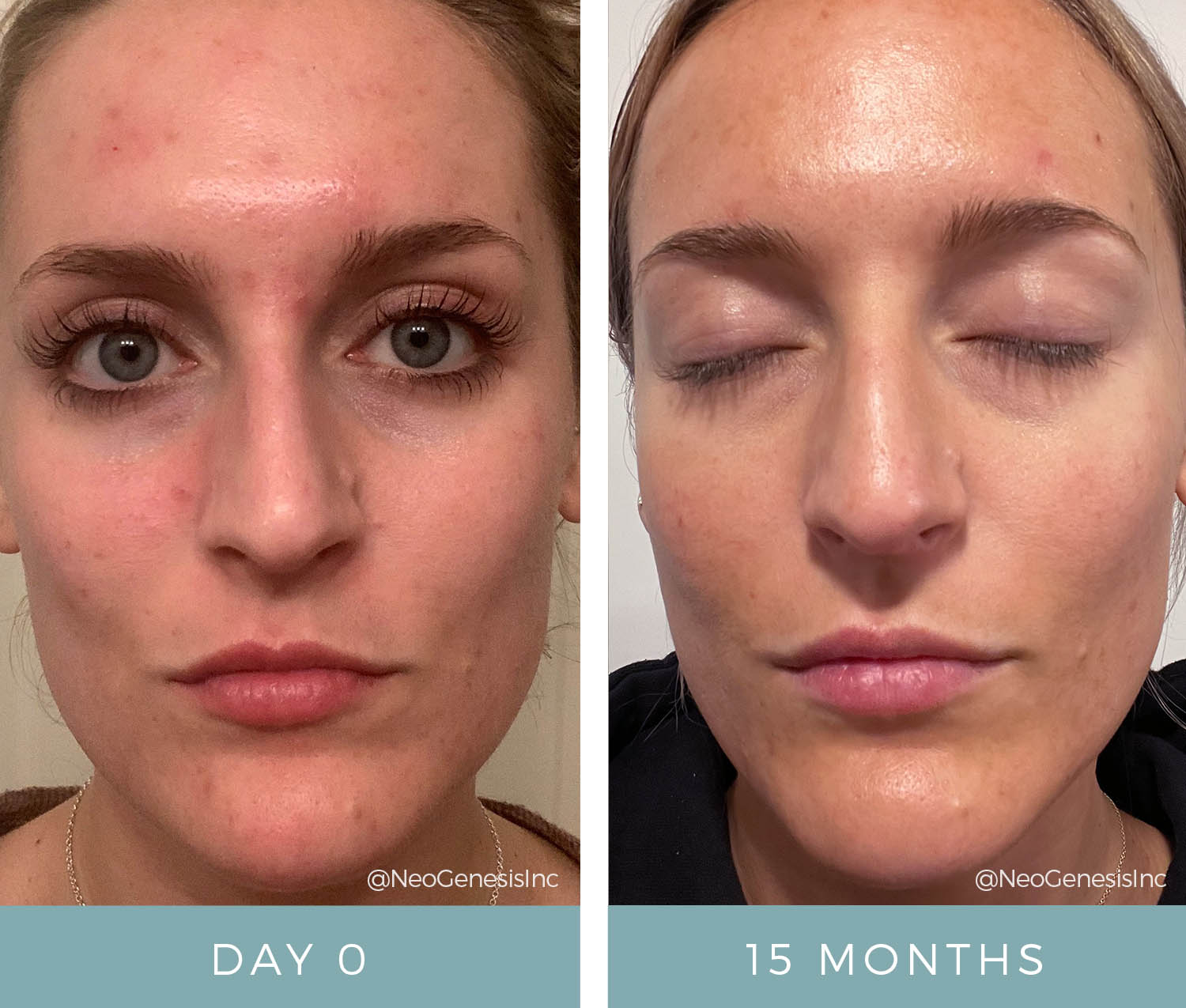 Before + After - Hormonal Acne