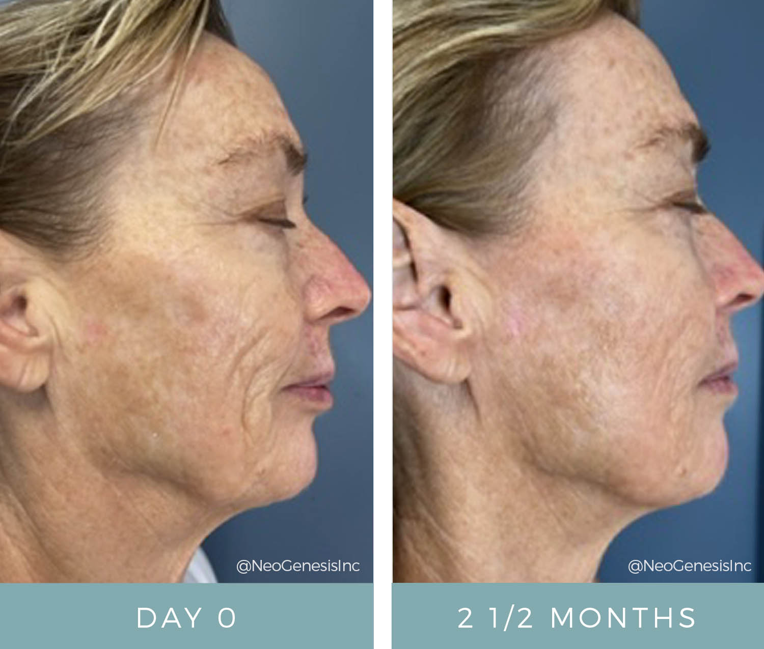 Before + After - Aging Skin, PIH, Melasma, Sun Damage, Skin Cancer