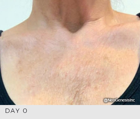 Aging Décolletage - Before NeoGenesis Skin Care Products