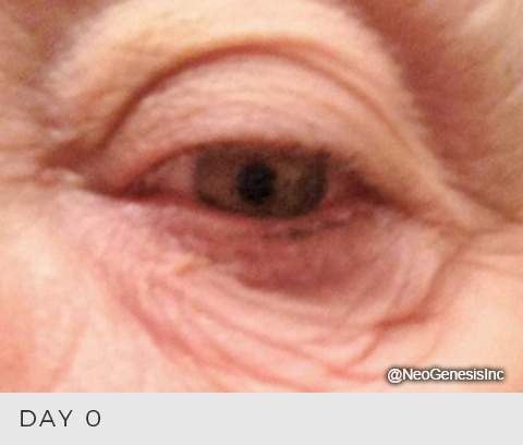 Aging Eye Area - Before