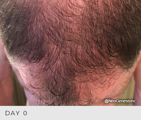 Before - Male Hair Loss