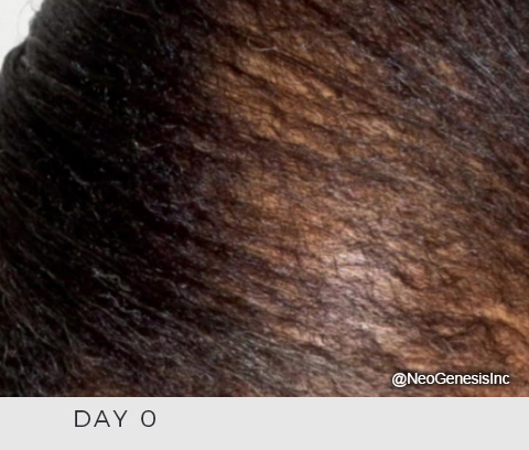 Hair Loss- Before NeoGenesis Hair Thickening Serum