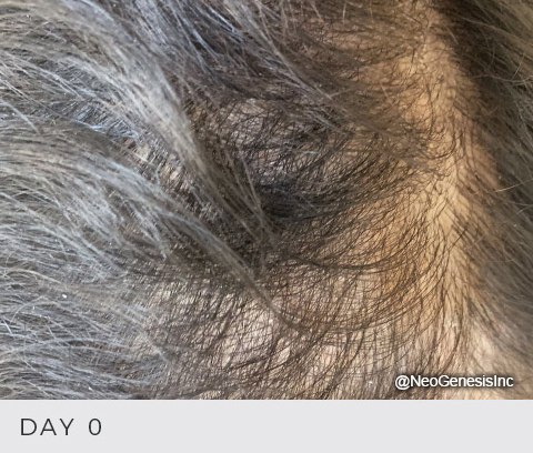 Day 0 - Hair Loss