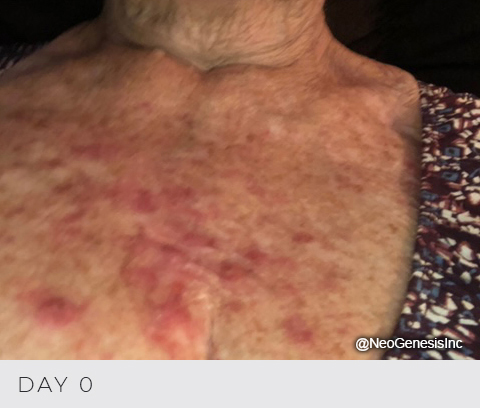 Before - Radiation Dermatitis