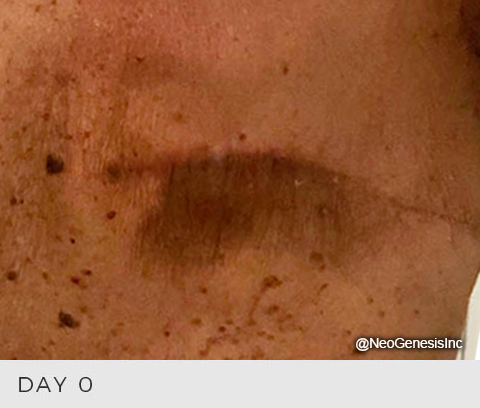 Radiation Dermatitis During Breast Cancer Treatment - Before