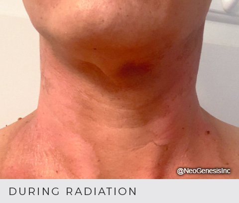 Before - Radiation - Head + Neck Cancer