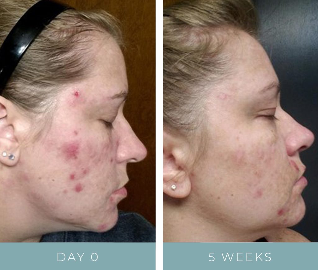 Chronic Acne - Before + After NeoGenesis Skin Care Products