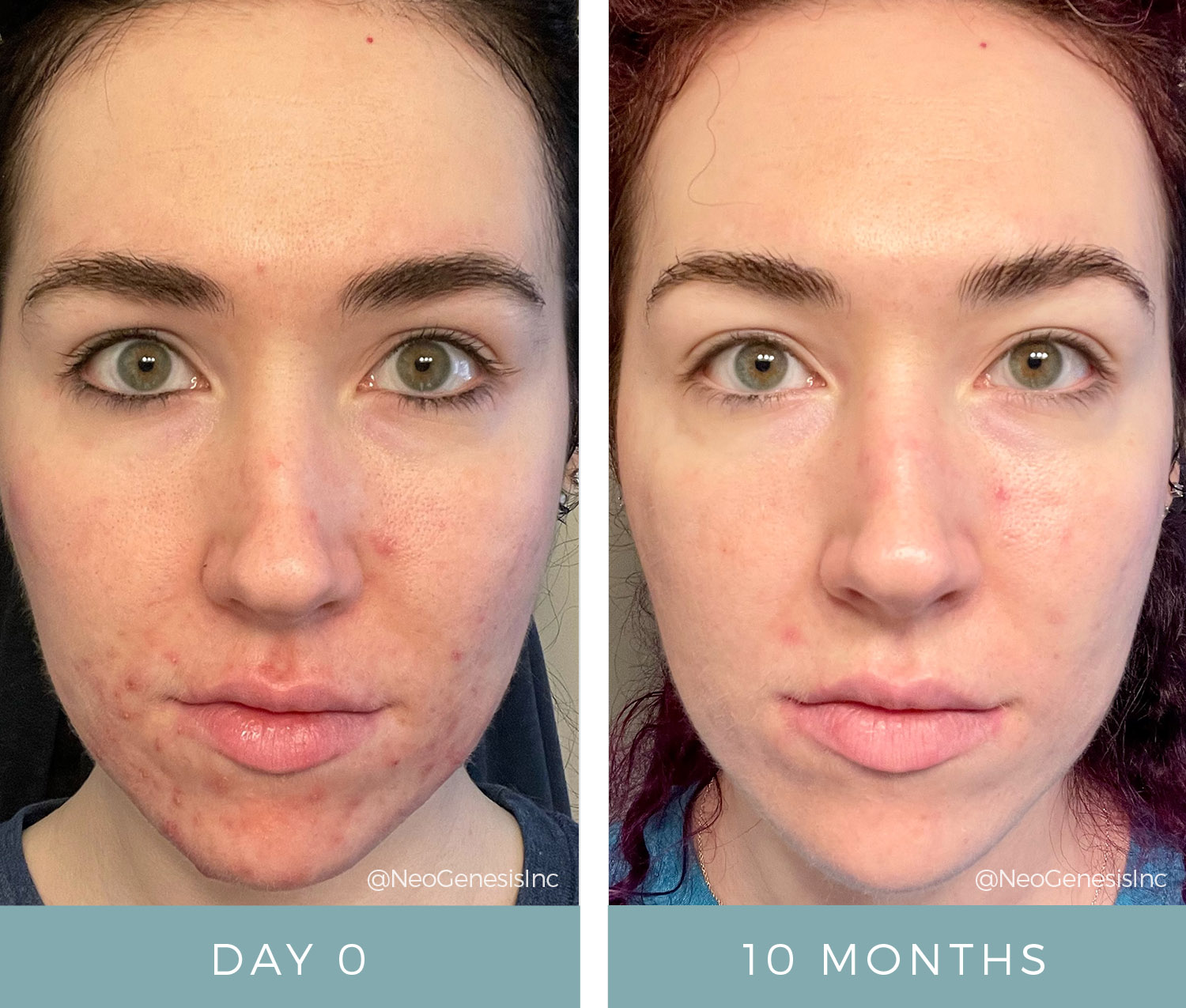 Acne - Before + After Microneedling and NeoGenesis Skin Care Products