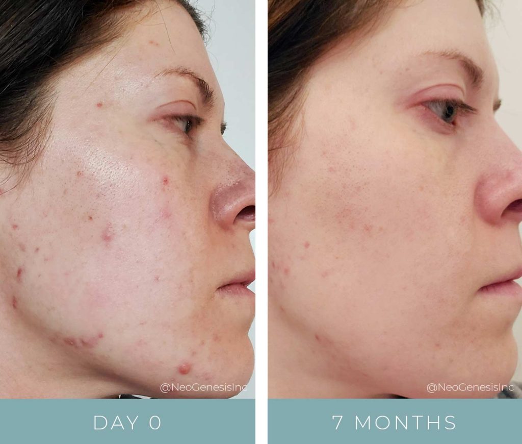 Hormonal Acne Breakouts - Before + After Photos
