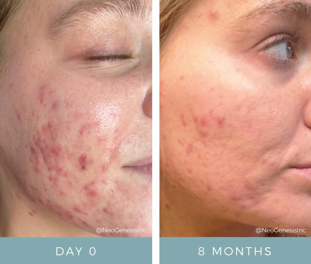 Hormonal Acne - Before + After Photos