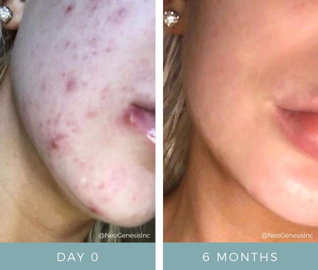 Acne - Before + After NeoGenesis Products