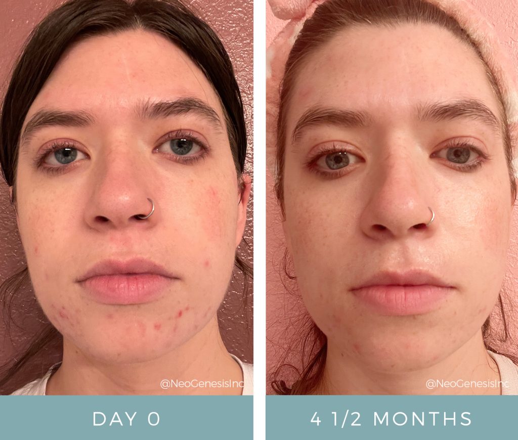 Cystic Acne + Maskne + Sensitive Skin - Before + After