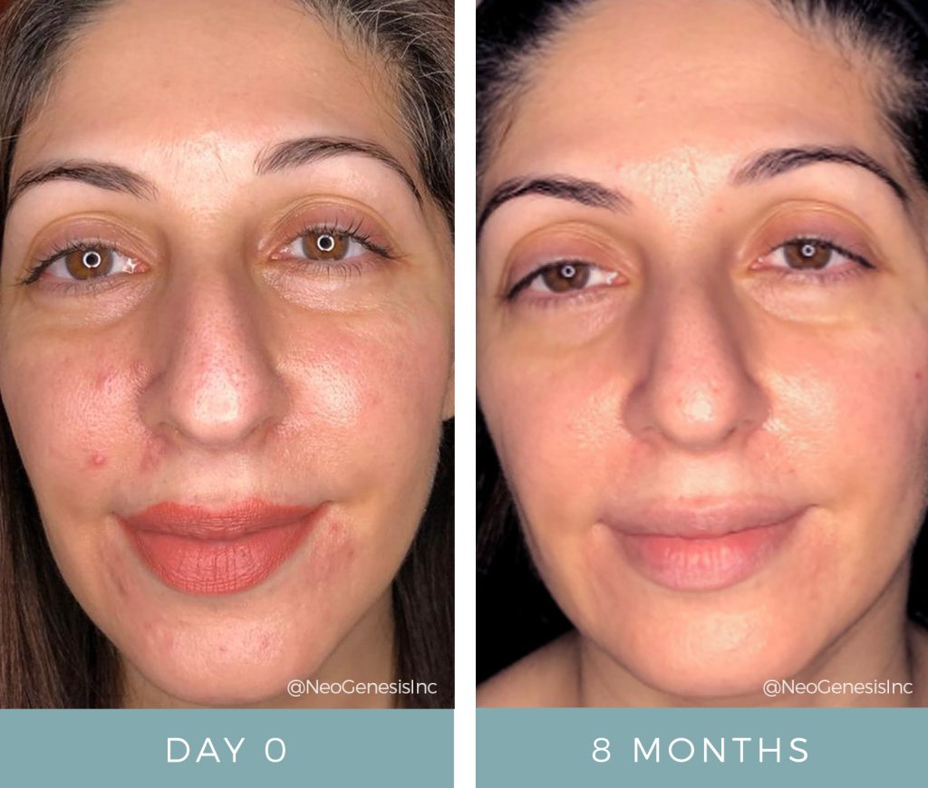 Acne - Before + After NeoGenesis Products for Blemish-Prone Skin