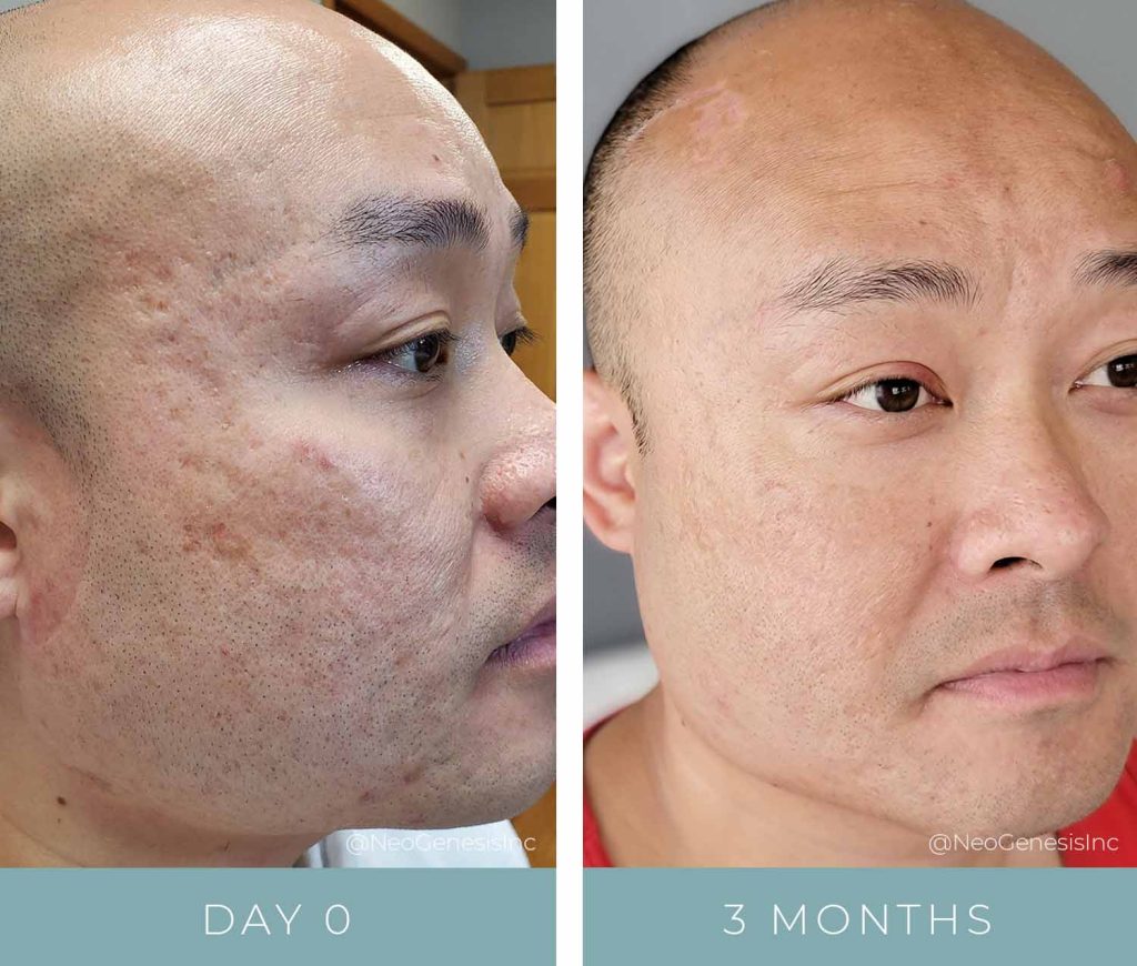 Acne + Acne Scarring - Before + After NeoGenesis Skin Care and Microneedling