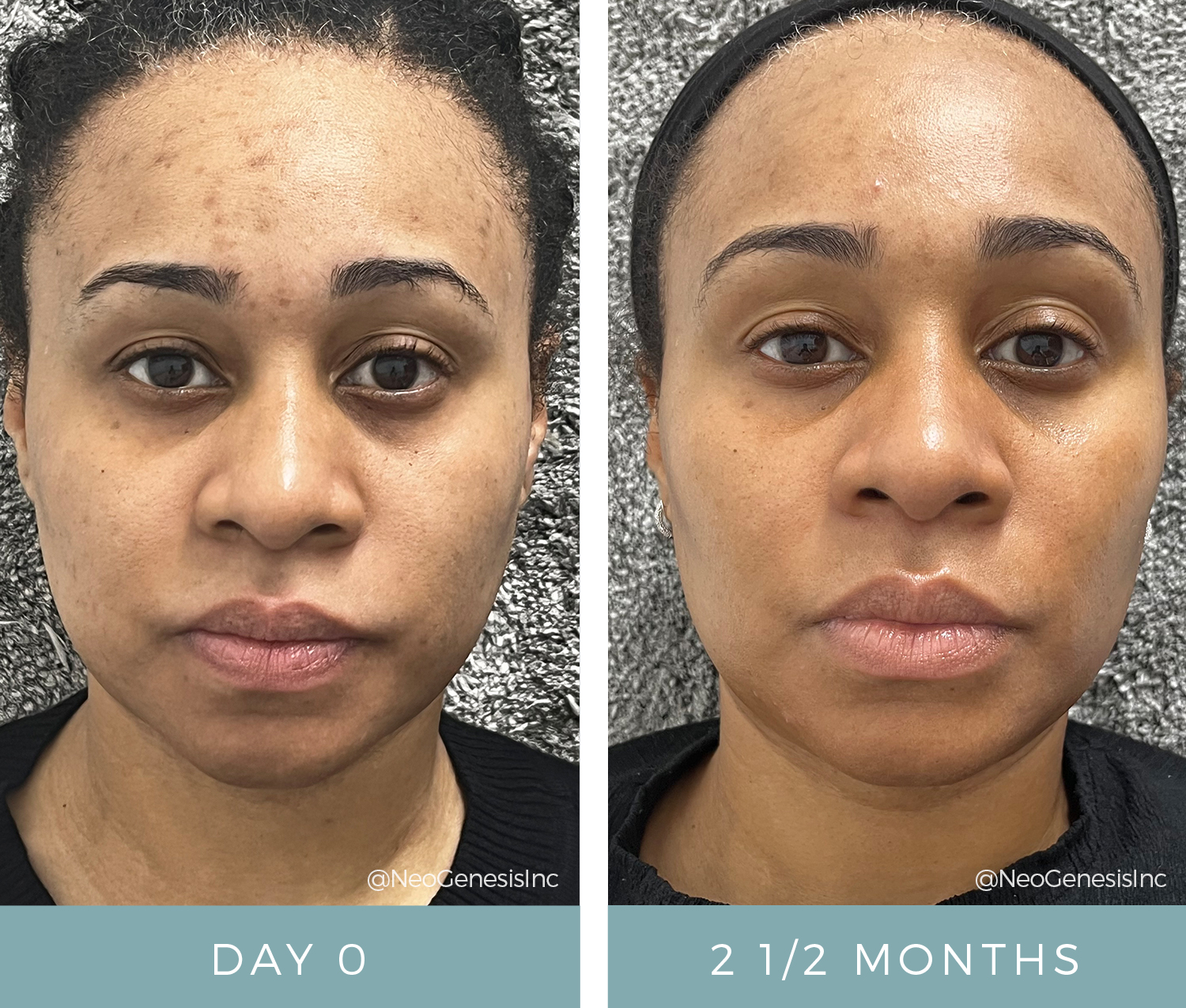 Maskne Acne + Acne Scarring - Before + After