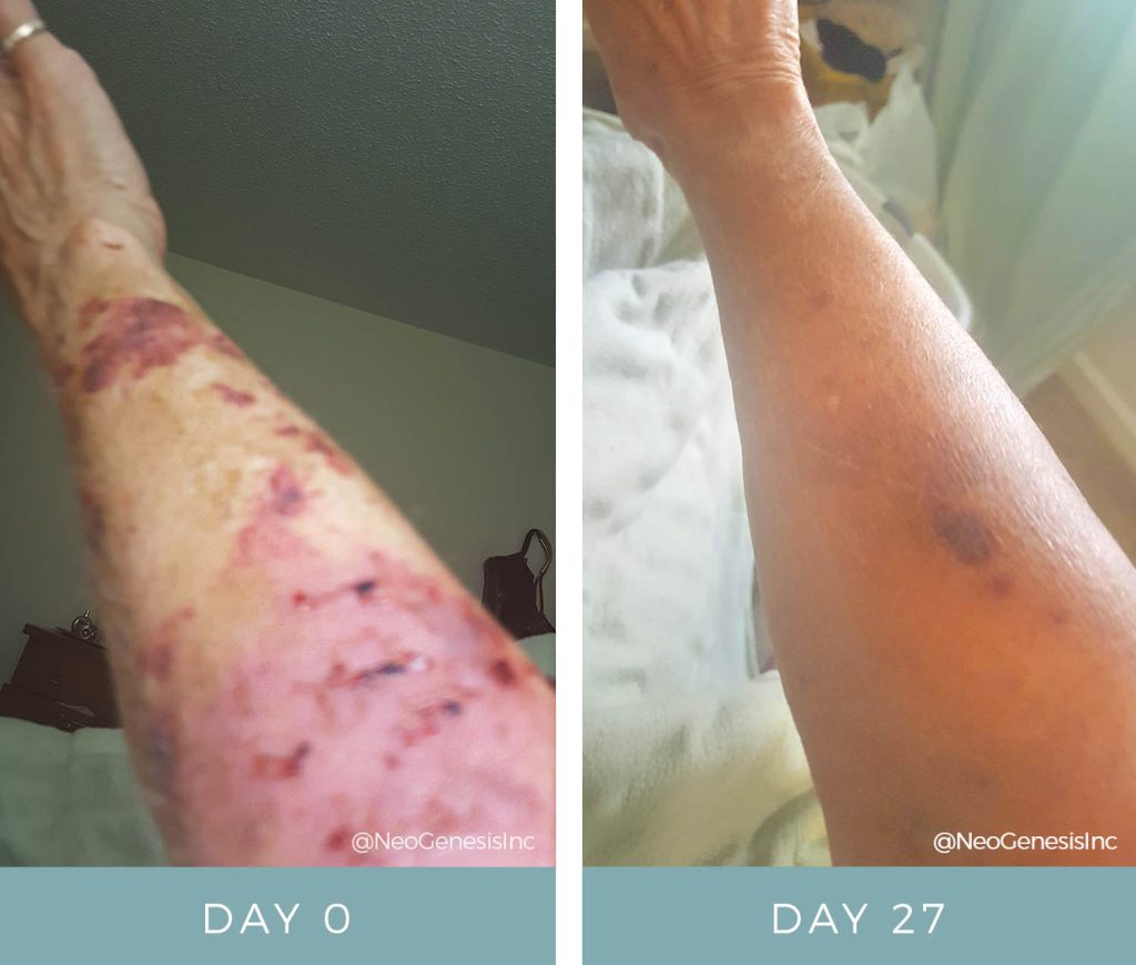 Actinic Purpura - Before + After NeoGenesis Recovery serum