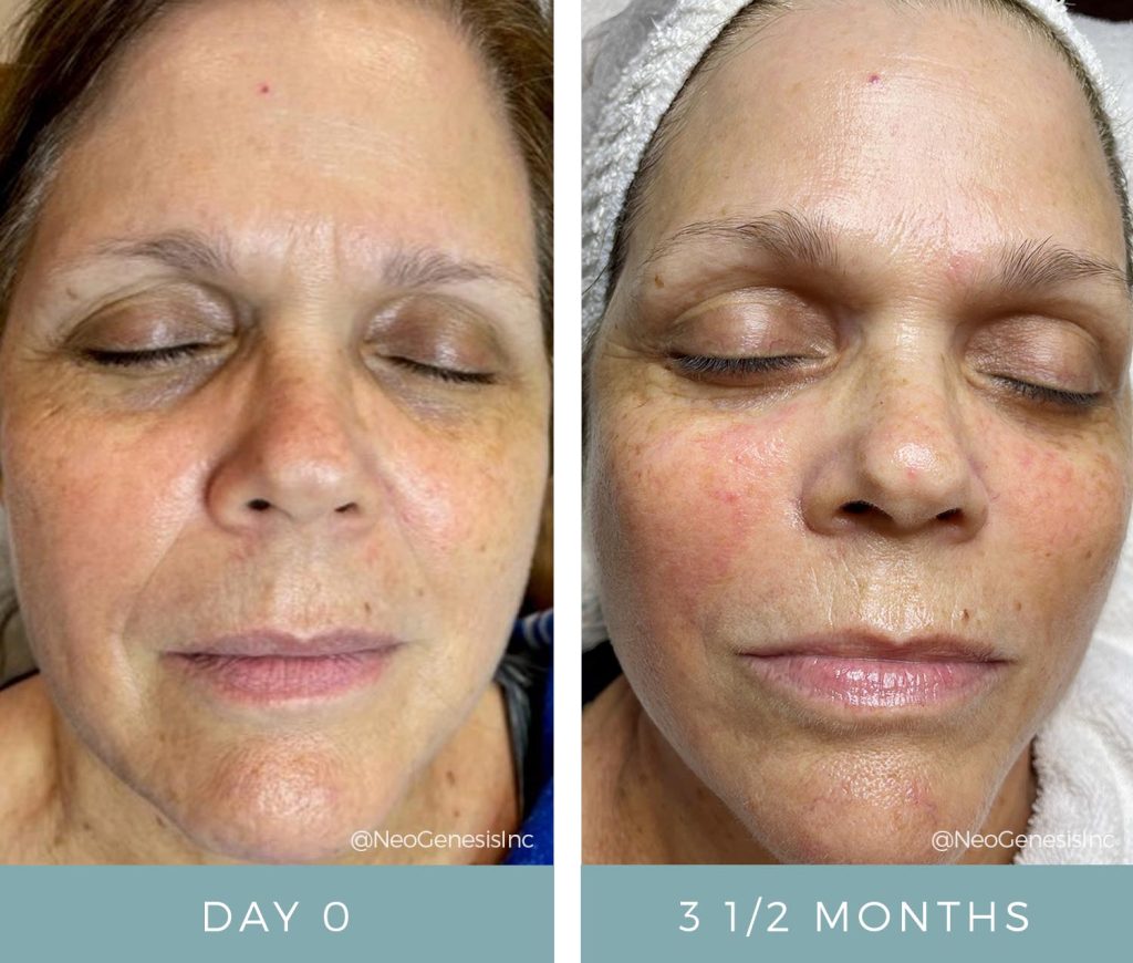 Aging Skin - Before + After