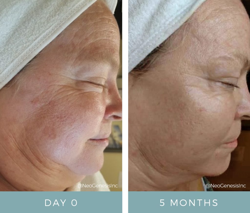 Aging Skin + Hyperpigmentation - Before + After Results