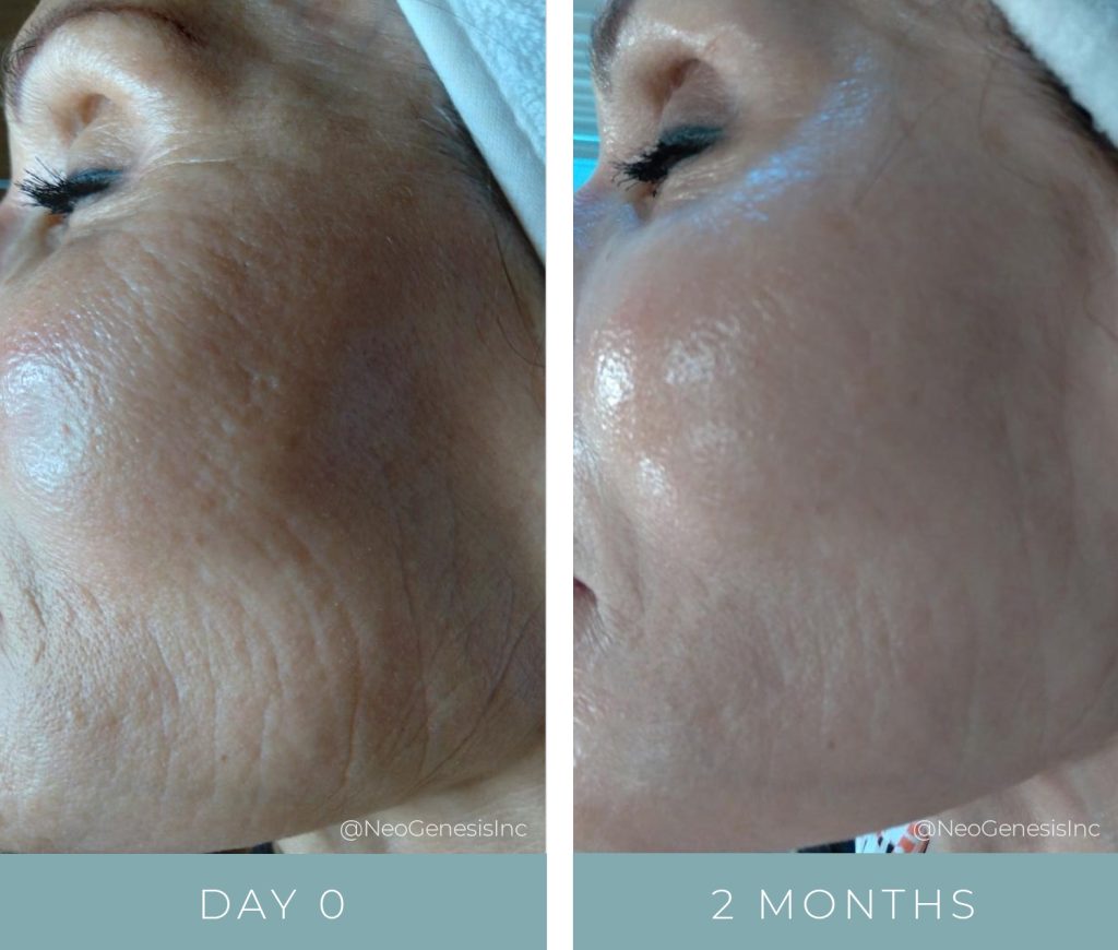 Mature + Aging Skin - Before + After Results