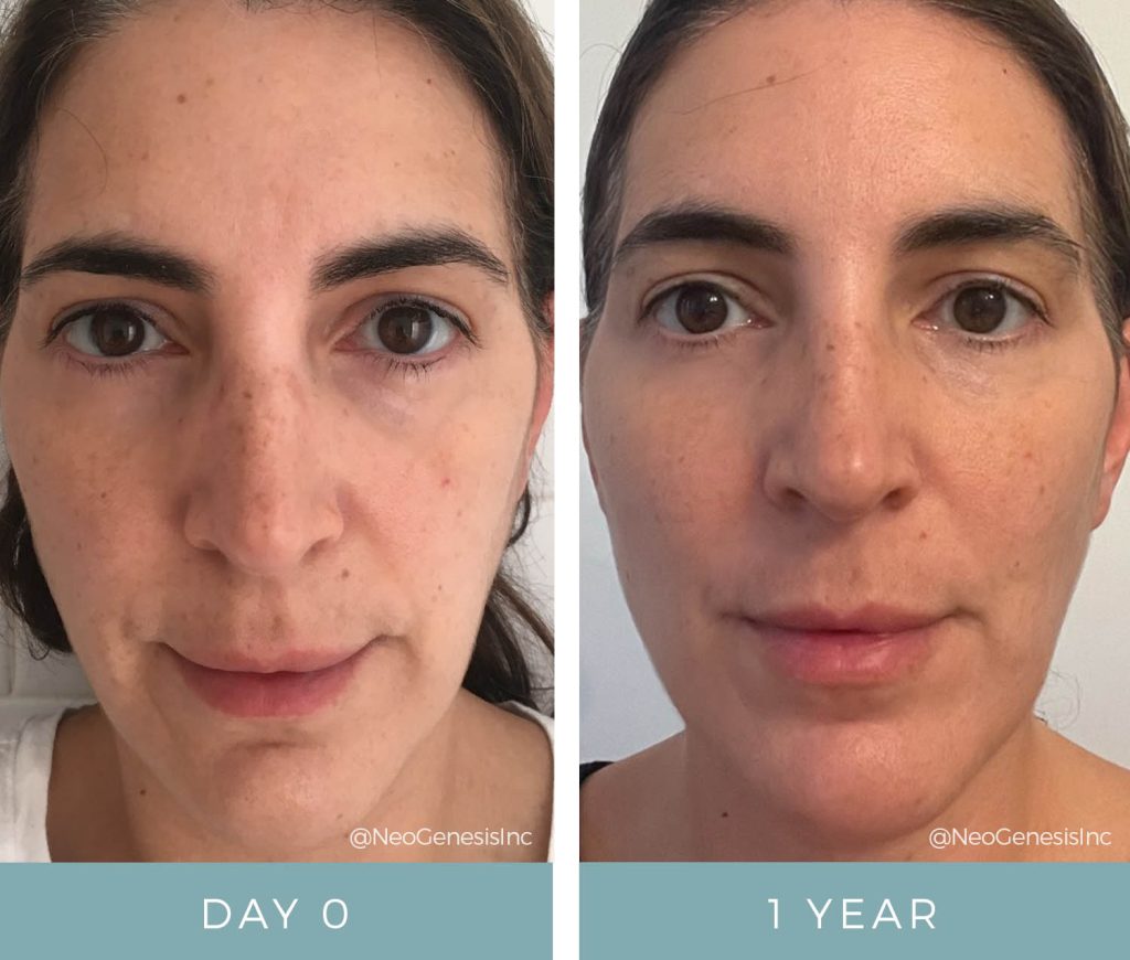 Aging Skin - Before + After Microneedling, HIFU and NeoGenesis Products