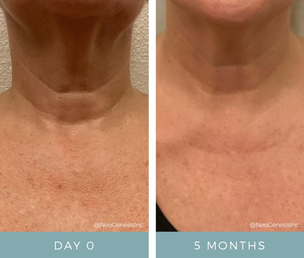Aging Neck - Before + After Results