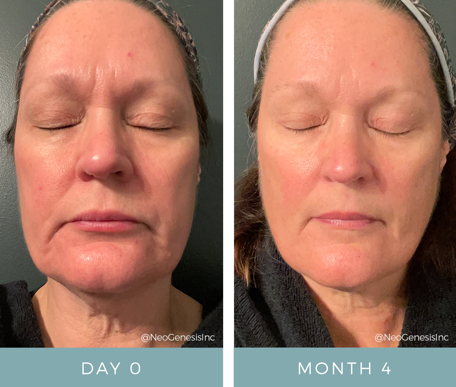 Aging Skin + Rosacea + Eczema - Before + After Results