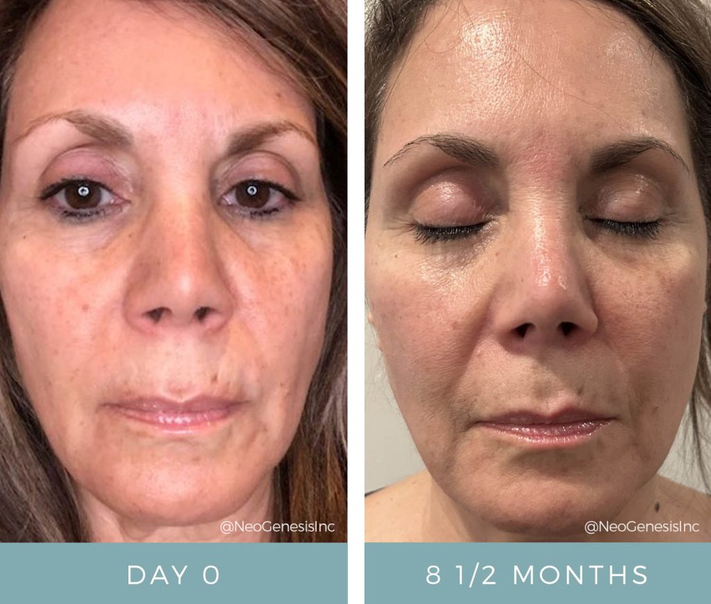 Aging Skin + Hyperpigmentation - Before + After