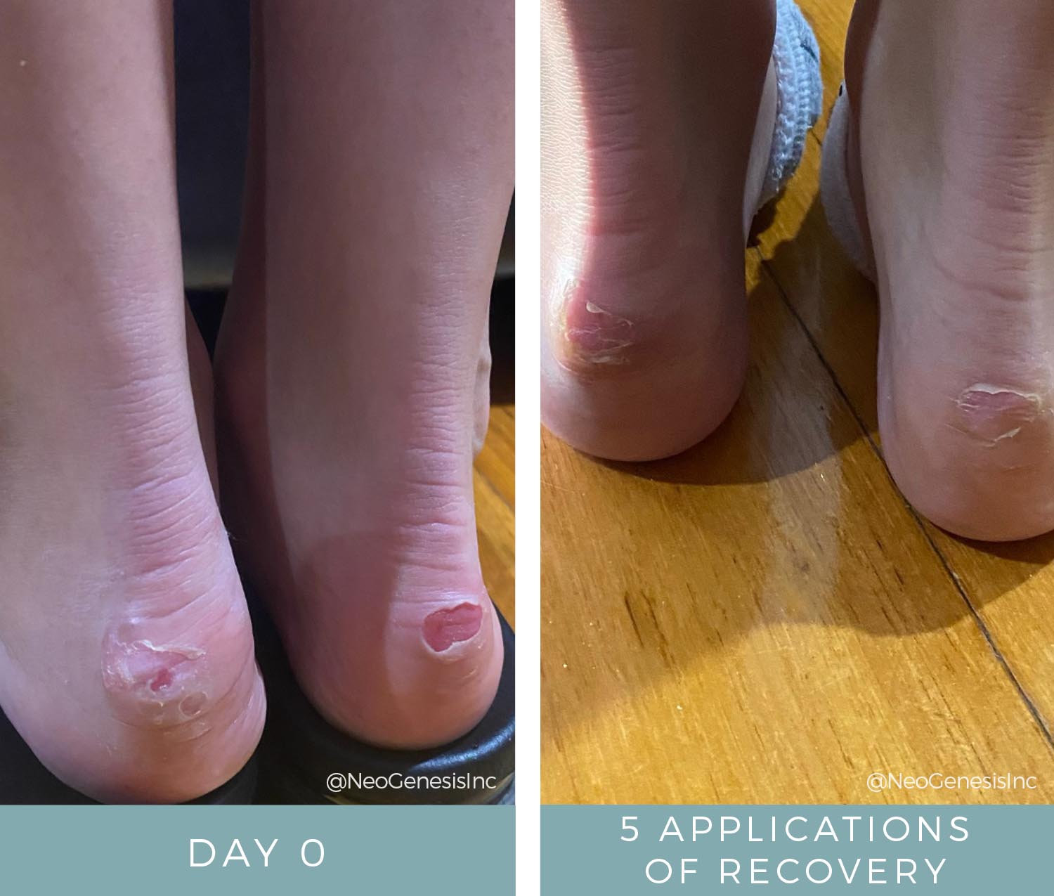 Wound Care for Ballerina Blisters - Before + After NeoGenesis Recovery Serum