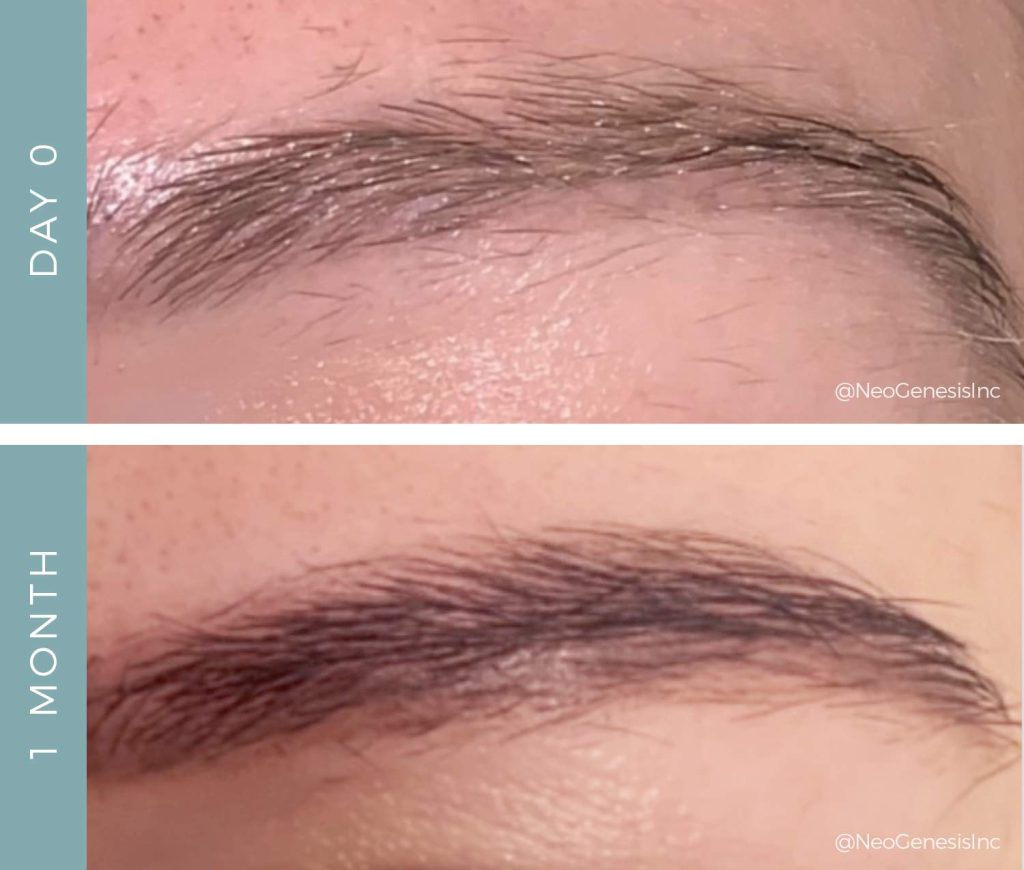 Brow Loss - Before + After NeoGenesis NeoBrow
