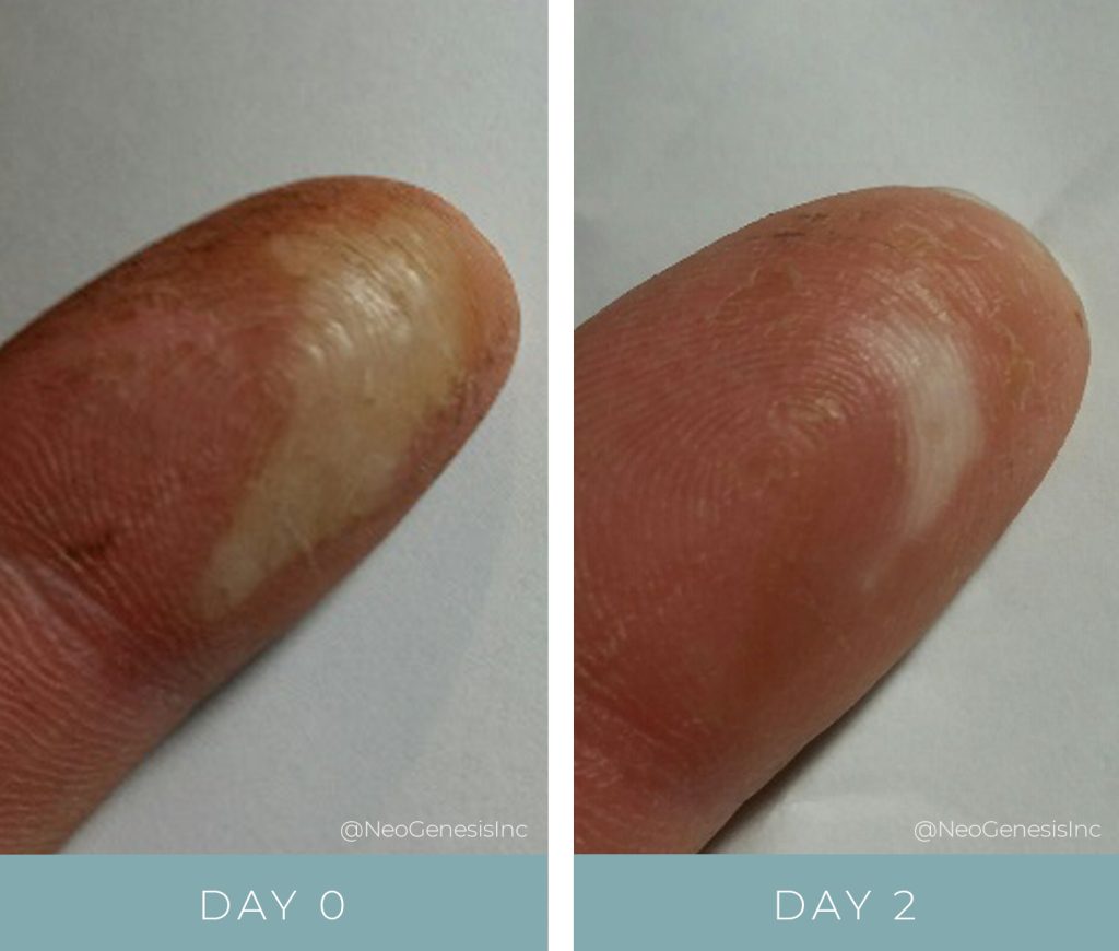 Wound Care for Burns - Before + After NeoGenesis Recovery Serum