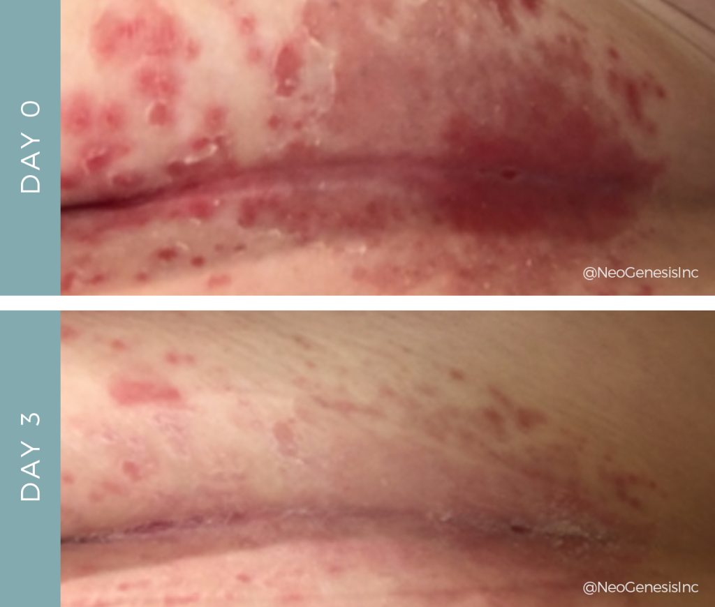 Chemotherapy Rash - Before + After