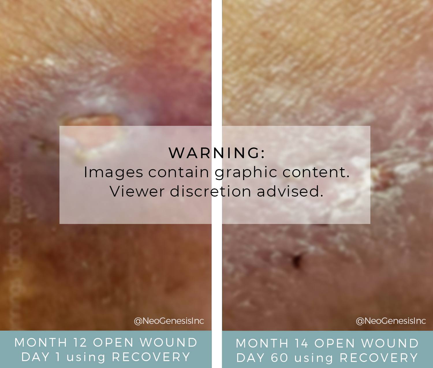 DVT Ulcer - Before + After NeoGenesis Recovery Serum