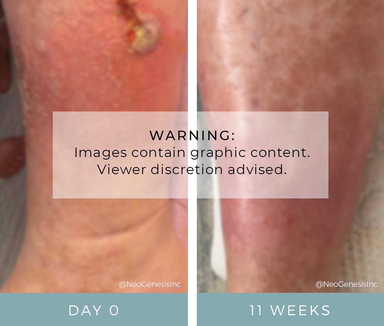 Diabetic Ulcers - Before + After NeoGenesis Recovery Serum