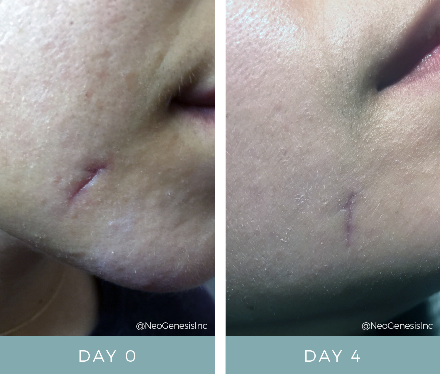 Dog Bite Scar - Before + After NeoGenesis Recovery Serum
