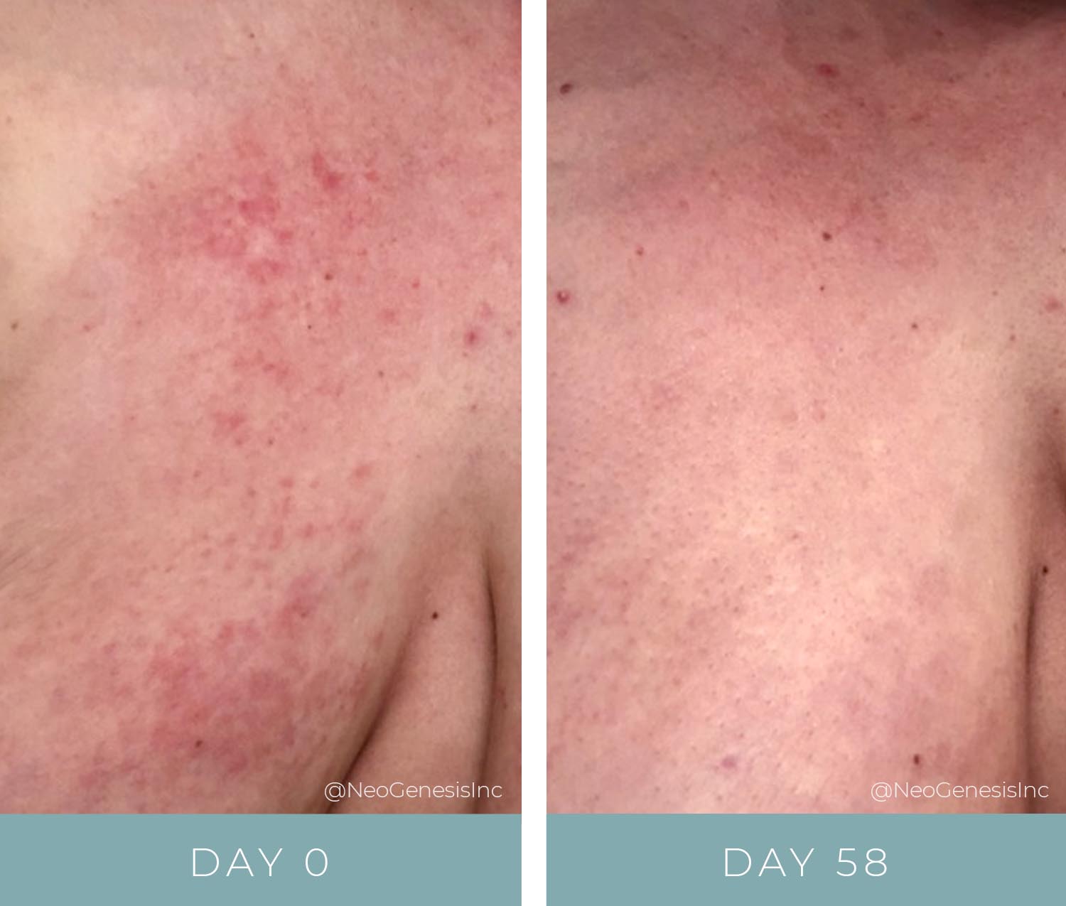 Eczema - Before + After NeoGenesis Recovery, Barrier Renewal Cream and MB-1
