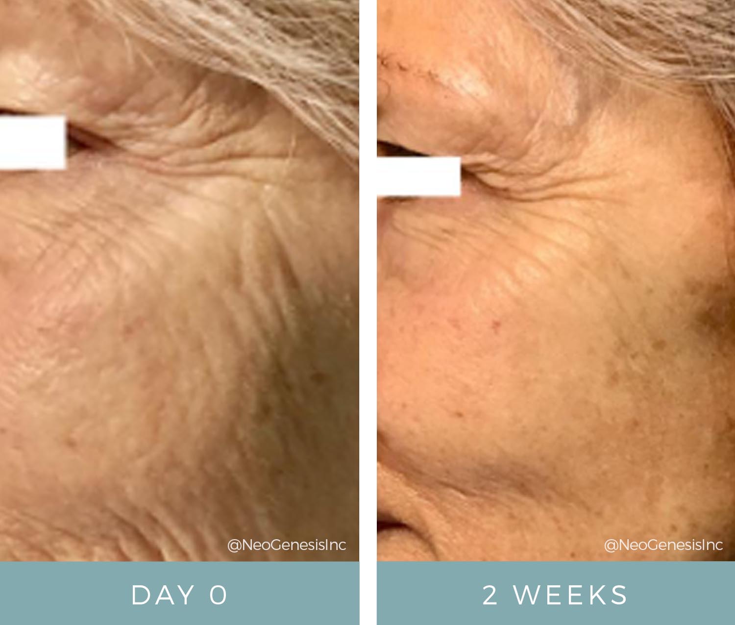 Fibroblast Skin Tightening - Before + After