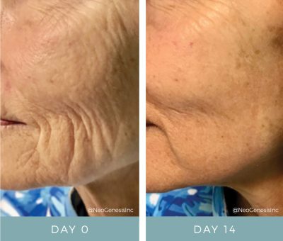 Before + After - Fibroblast