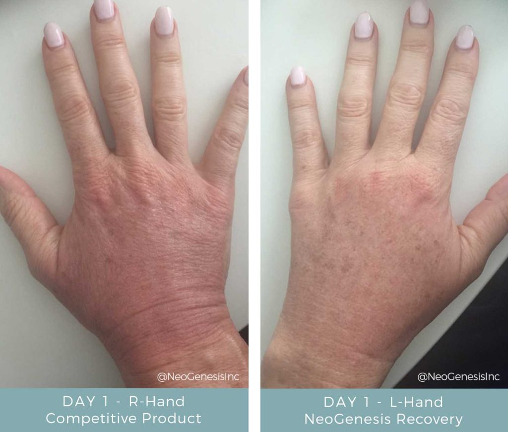 Before + After - Fraxel Laser Treatment Skin Care