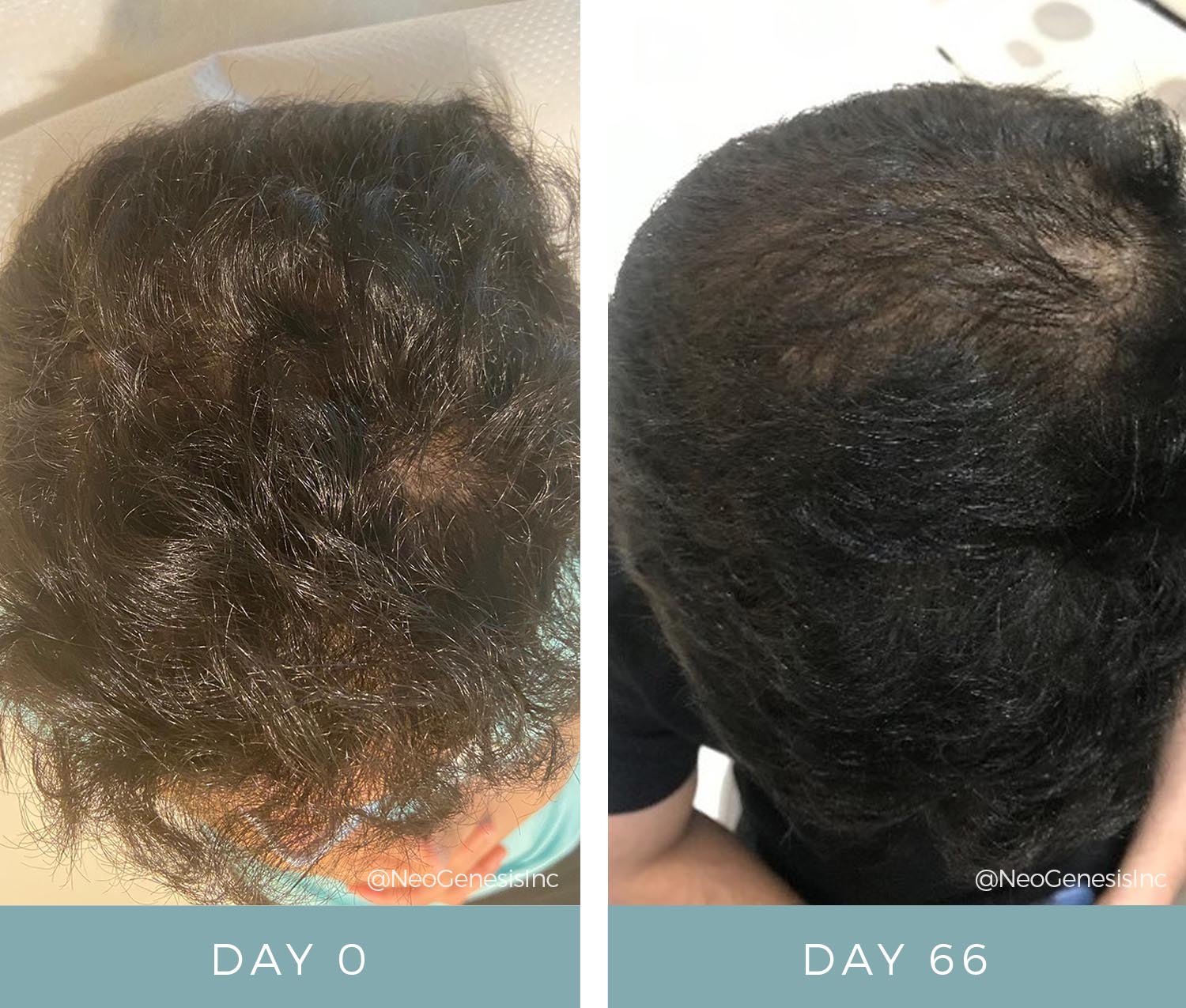 Hair Loss + Microneedling Treatments - Before + After