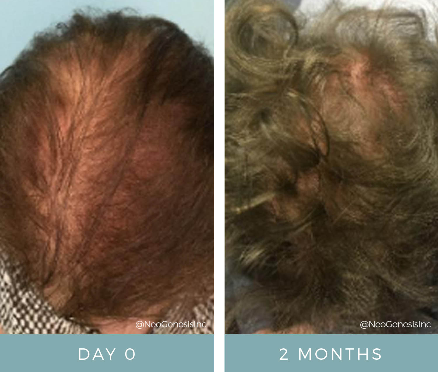 Hair Loss - Before + After NeoGenesis Hair Thickening Serum