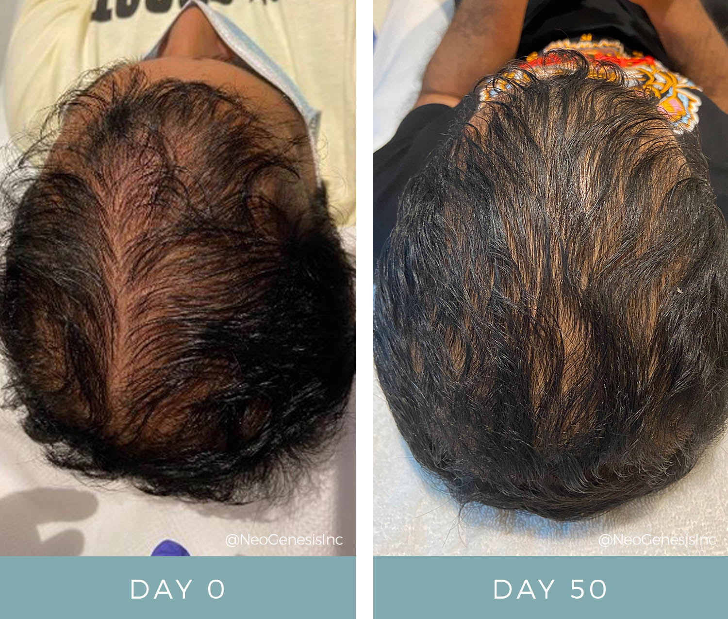 Hair Loss + Microneedling - Before + After
