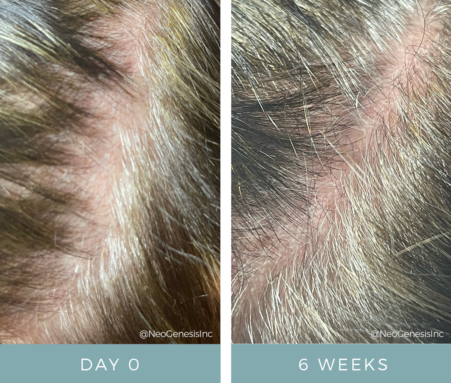 Before + After - Microchanneling + NeoGenesis Hair Thickening Serum for Hair Loss