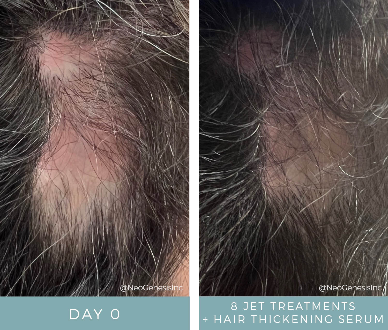 Hair Loss + JET Treatments - Before + After